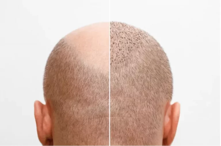 زراعة الشعر: المراحل والتوقعات